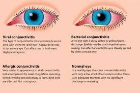 Image result for Conjunctivitis Resources
