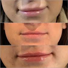 Filler Dissolving | Fox Aesthetics