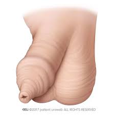 Image result for Phimosis