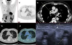 The qualitative assessment was statistically different (p=0.0020, χ). Covid 19 In The Act Incidental 18f Fdg Pet Ct Findings In Asymptomatic Patients And Those With Symptoms Not Primarily Correlated With Covid 19 During The United Kingdom Coronavirus Lockdown Springerlink