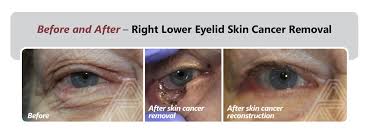 Wikimedia) warts, caused by papilloma virus can appear on the eyelid. Eyelid Facial Skin Cancer Triad Eye Institute