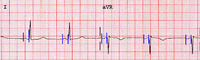 Ecg Primer Calculations