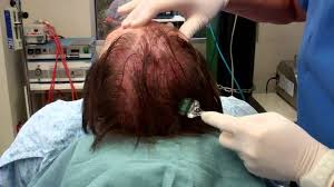 Case report of two successful treatments with the excimer laser. Hair Loss Scarborough Augusta Me Scarborough Augusta Me Maine Laser Skin Care