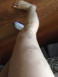 Is It Normal To Have Extreme Bruising Hard Lumps Bumps Under The Skin After Sclerotherapy For Superficial Spider Veins Photo