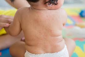 Kulit akan mengalami gatal dan disertai dengan bintik merah. 9 Penyebab Bintik Merah Pada Bayi Manakah Yang Perlu Diwaspadai Theasianparent Indonesia