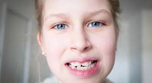 Addressing Youth Traumatic Dental Injuries