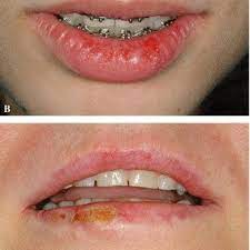 However, a variety of symptoms may appear in the mouth or. Examples Of Clinical Manifestation Of Herpes Simplex Virus Type 1 Download Scientific Diagram