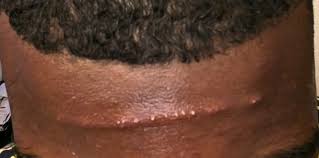 How can i get rid of pimples on my forehead? Stop Durag Acne By Tying Wave Cap Correctly For No Forehead Pimples
