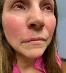 Mohs Surgery: A Precise Approach to Treating Skin Cancer