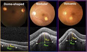 Image result for lesion sclera