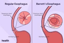Image result for esophagus