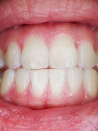 These natural remedies for sore gums really do work and you can use things you likely have handy in your home. How To Stop Receding Gums Treatments Pain Solutions And Expert Advice
