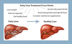 Is Your Weight Putting You At Risk For This Silent But Deadly Disease Fatty Liver Fatty Liver Treatment Fatty Liver Detox