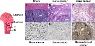 Survival rates can give you an idea of what percentage of people with the same type and stage of cancer are still alive a certain length of time (usually 5 years) after they. Dichotomic Effects Of Clinically Used Drugs On Tumor Growth Bone Remodeling And Pain Management Scientific Reports