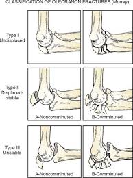 The olecranon serves as a lever for the extensor muscles that straighten the elbow joint. Fractures Of The Olecranon Musculoskeletal Key