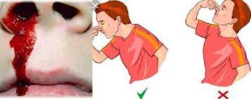 Hidung berdarah atau epistaksis ini sering berlaku apabila salur darah kecil (kapilari) rongga hidung pecah disebabkan beberapa punca. Jangan Dongak Kepala Jika Hidung Berdarah Lakukan Langkah Ini Ketika Pendarahan Hidung Berlaku