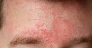 Egzama Nedir Neden Olur Ve Belirtileri Nelerdir Evde Dogal Tedavi Ile Egzamaya Ne Iyi Gelir Nasil Gecer Saglik Haberleri