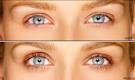 Lash-Lengthener Latisse Is Glaucoma Drug Lumiganaposs Second Life