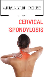 Cervical Spondylosis Also Known As Osteoarthritis Is A Common Health Condition That Affects Neck J Cervical Spondylosis Cervical Arthritis Treatment