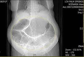 Image result for Adynamic Ileus