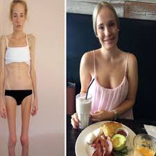 Anorexic self-harmer who weighed 4.5st makes miraculous recovery: I had 48  hours to live - Daily Star