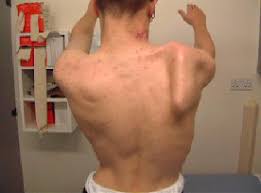 We did not find results for: Obstetric Brachial Plexopathy Erb S Klumpke S Palsy Pediatrics Orthobullets