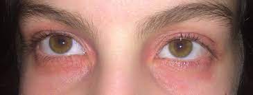 Ekzem Ums Auge Und Am Arm Was Konnte Das Sein Haut Augen Allergie