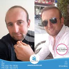 Degisime Ve Yenilenmeye Bas Tan Baslayin Anatolia Sac Ekim In 10 Yil Kampanya Firsatini Kacirmayin Tum Sorulariniz Icin 90 532 781 89 20 Sac Yelken Moda