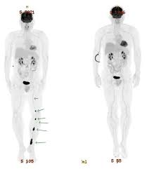 Parenteral morphine is widely used for dyspnea of imminently dying cancer patients, but the outcomes to expect over time remain largely unknown. New Immunotherapy Drug Effective For Melanoma Other Cancers