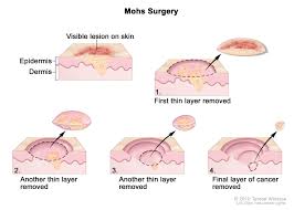 The word benign means they're not cancer. Soft Tissue Sarcoma Types Staging Treatment Dana Farber Cancer Institute Boston Ma