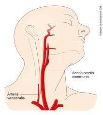 Halsschlagaderverengung Karotisstenose Deximed
