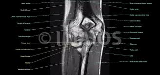 Maybe you would like to learn more about one of these? The Elbow Mr Medical Imaging Anatomical Atlas