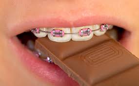 How to get rid of them? 5 Foods To Avoid If You Have Braces St Lawrence Dentistry