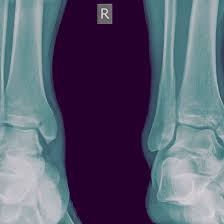 The term medial refers to a point closer to the center of the body. Medial Malleolus Fracture And Broken Ankle Treatment