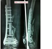 A Novel Method to Fix Type C3 Distal Femur Fractures with ...