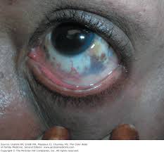 Image result for nevus sclerae
