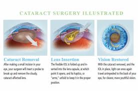 Image result for Cataract Extraction