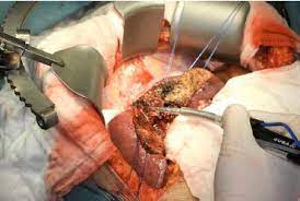 Indeed, indications to surgery for primary and secondary tumors of the liver have been. The Aim Of Technology During Liver Resection A Strategy To Minimize Blood Loss During Liver Surgery Intechopen
