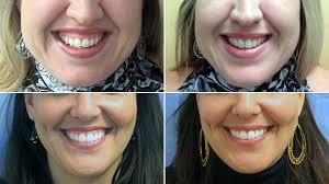 Bothered by a 'Gummy Smile'