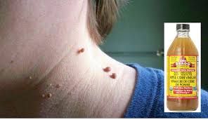 For more information and source, see on this link : Tak Rasa Sakit Buang Sendiri Daging Seakan Akan Kutil Pada Leher Guna Cuka Epal Maskulin