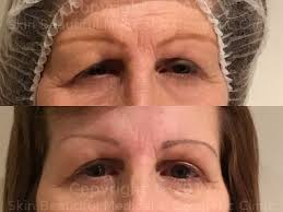 Pdo Eyebrow Thread Lift Before After By Helenbowes The Only Apdot Accredited Trainer Outside Of London