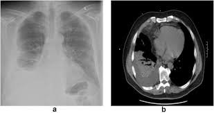 Lesions light rw light&#x27;s liver loculated lung cancer lung transplantation lupus lymphatic lymphocytes lymphoma malignant mesothelioma malignant pleural effusions mediastinal mesothelial cells mesothelioma occur pancreatic. Case Report Steroid Responsive Mesothelioma Related Pleural Effusion Sciencedirect