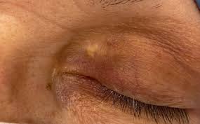 Image result for xanthelasma of eyelid