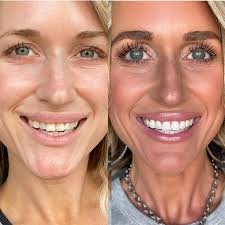 Teeth whitening can be painful, especially if you have sensitive teeth like  me! This is the ONLY kit that doesn't not hurt my teeth and actually works!  On crazy good s a l e