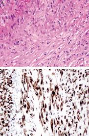 Unfortunately, mesothelioma cells are almost always malignant. Problems In Mesothelioma Diagnosis Addis 2009 Histopathology Wiley Online Library