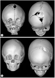 كيف يتم تشخيص التحام الجمجمة؟