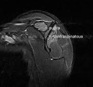 Parsonage Turner Syndrome Mri Dr Balaji Anvekar Frcr