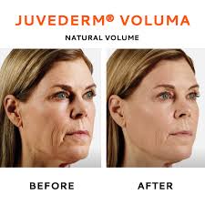 See before and after juvederm pictures from the cosmetic skin clinic. Dermal Fillers Facial Fillers Wrinkle Fillers Cocoon