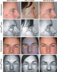 Splitface study of melasma patients treated with nonablative fractionated  photothermolysis (1540nm)