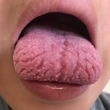 Image result for Fissured tongue
